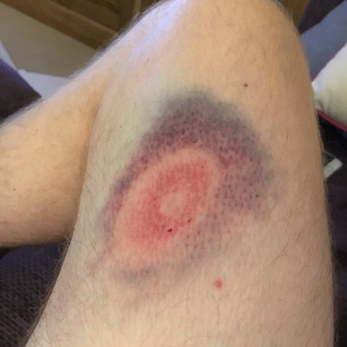 Andi_Mac's tweet photo. Ran down a #dragflick today. His accuracy was off... #bruise looks like an @RoyalAirForce #Roundel #1Runner #NSHC https://t.co/GHBWImdh8y