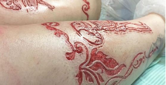 TattoosHeaven's tweet photo. Scarification Is The New Tattooing Technique https://t.co/979gCyj78x https://t.co/jim8jNBO9y