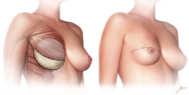 Join the discussion! Single stage vs two stage #BreastReconstruction today and tomorrow! #PRSJournalClub