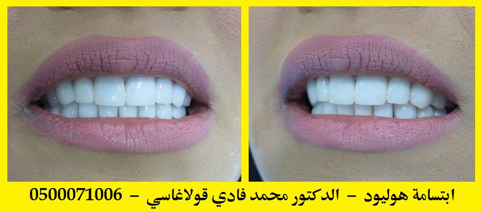 #تقويم #اسنان #لومينير #فينير #زراعه #عدسات #تبيض #ابتسامة #هوليود #زركون #تركيبات #عيادة #لومينيرز #تجميل #لومينيرز