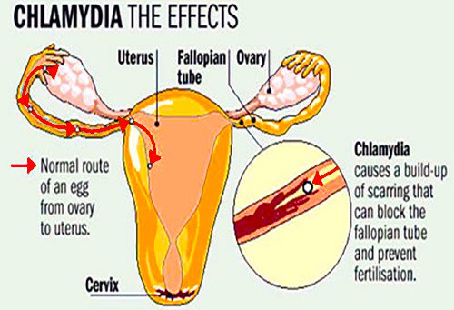 HealthCleveland's tweet photo. Symptoms of chlamydia and some other information you need to know https://t.co/mwZBLqf9I5 https://t.co/FIwlrQei9O