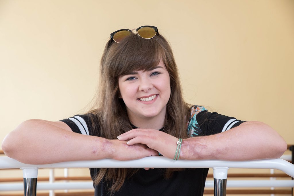 Nottingham University Hospitals (@nottmhospitals) on Twitter photo A student who lost the fingers on her left hand to meningitis has got her confidence back thanks to <a href="/GloversLiveryCo/">Glovers Livery Co</a> bit.ly/2d51TqP A student who lost the fingers on her left hand to meningitis has got her confidence back thanks to <a href="/GloversLiveryCo/">Glovers Livery Co</a> bit.ly/2d51TqP