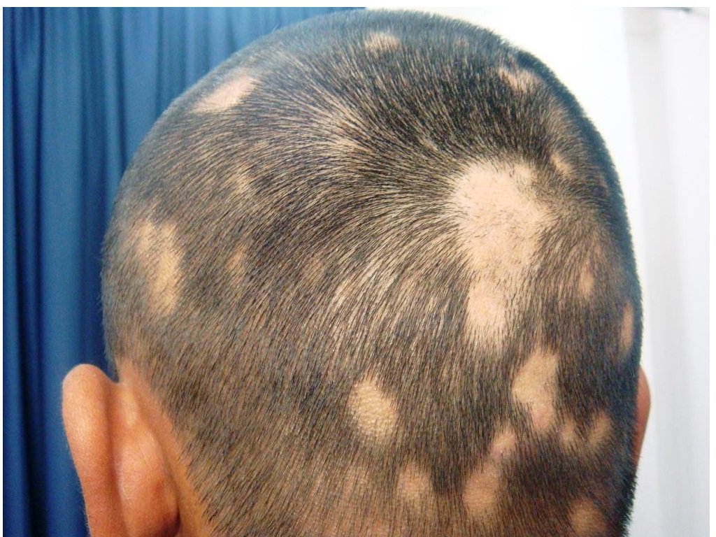 Don_Guiot's tweet photo. Alopecia areata en CVID. #PFisiopatologicos https://t.co/qYBHzALXtJ