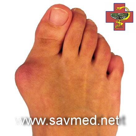 Кости на стопе растут. Деформация стопы халюс вальгус. Степени вальгусной деформации 1 пальца. Кости на стопе растут. Косточка на ноге начальная стадия.