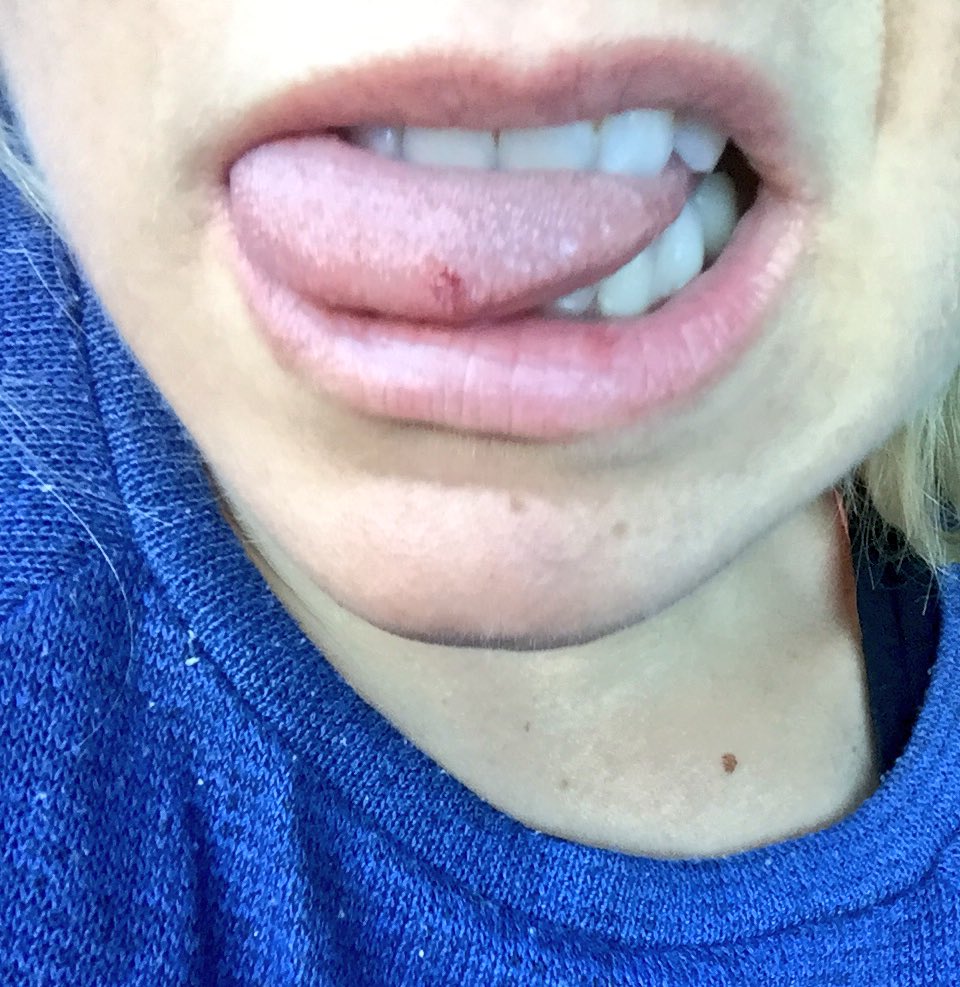 mooreynumberone's tweet photo. Tried to get my lunch into my face at 600mph, I took a bite out of my tongue in the process... #famished #reducedtotears π©π₯ #whyme https://t.co/8hk5MjoB4B