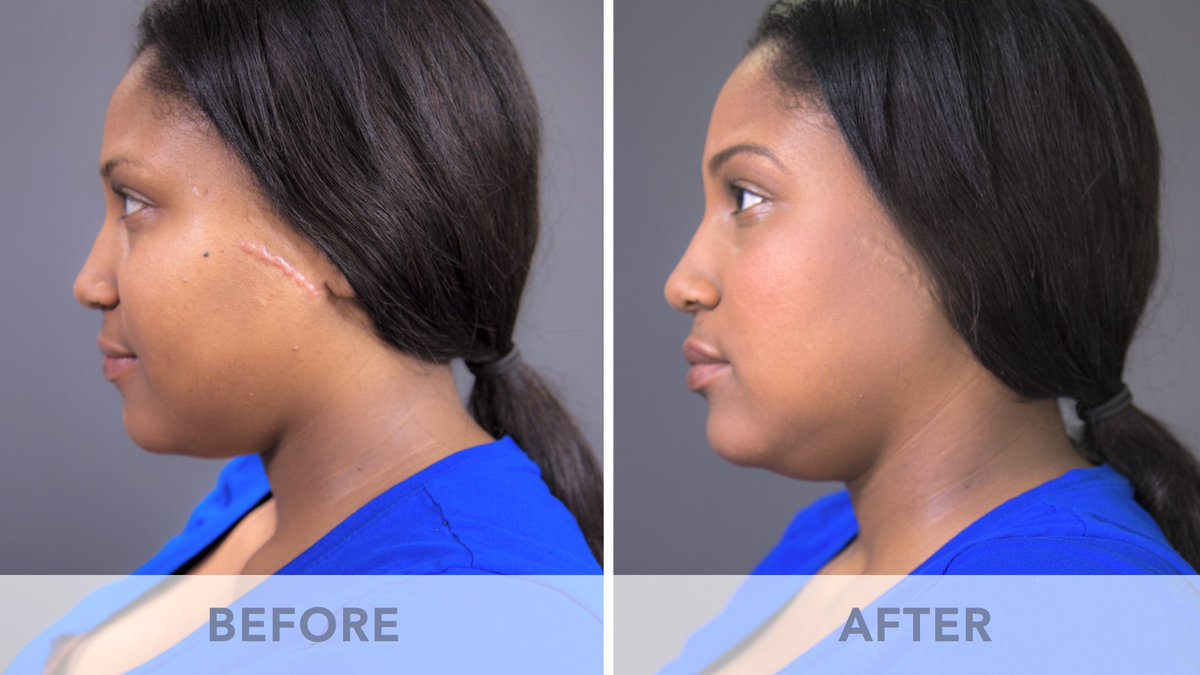 lindaseidelpro's tweet photo. Sharquetta has a scar she wants to conceal, tune in Wednesday to see why she chooses Linda Seidel Cosmetics! https://t.co/IItaKB6lgL