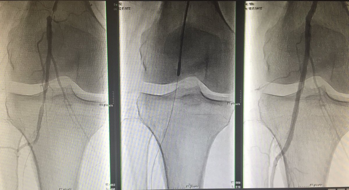 #vesselprep #Jetstream #DCB #palpablepulse #nostent <a href="/MountSinaiIR/">Mount Sinai IR</a> <a href="/EVToday/">Endovascular Today</a> <a href="/bsc_pi/">Jeff Mirviss</a>