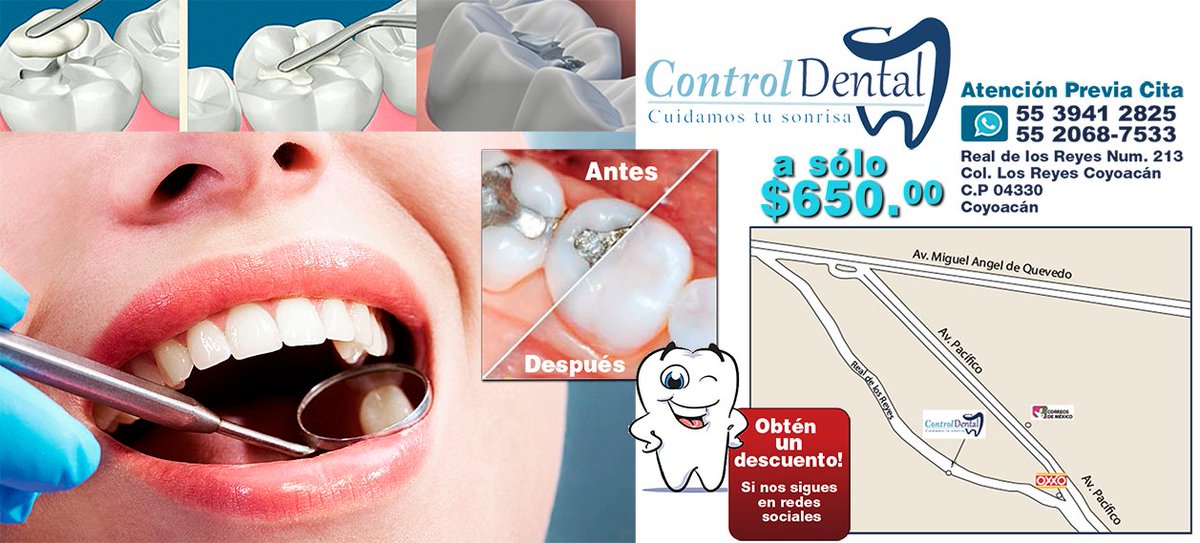control_dental's tweet photo. #FelizLunes Todavía tienes esas viejas amalgamas? https://t.co/dhf25LfRNc @todomercadomx @VillaCoapa_ @TlalpanVecinos @VendoCDMX @Klasifica2 https://t.co/BimeSg5FBd