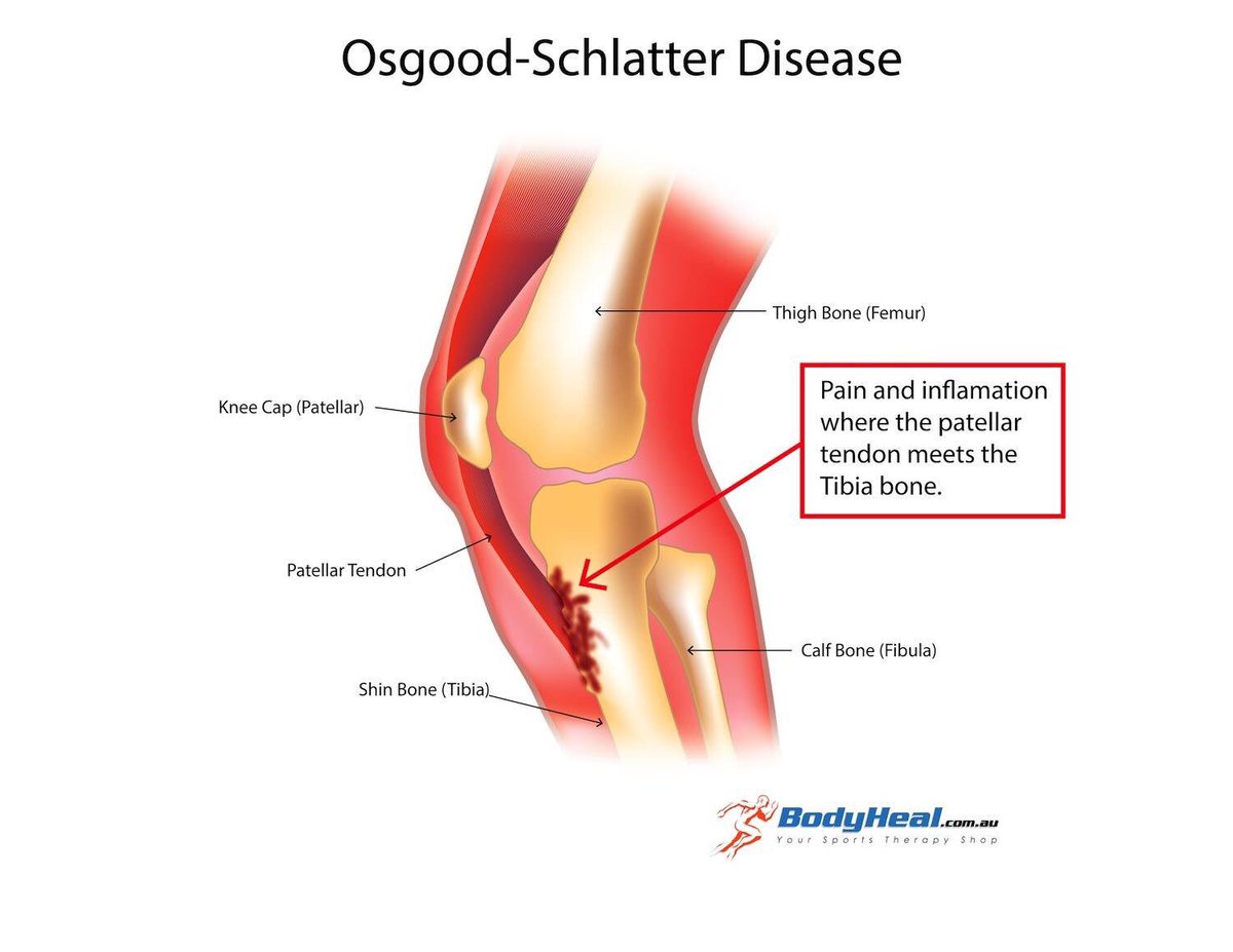 tgnpodiatry's tweet photo. Knee pain?? @tgnpodiatry #podiatry #traralgonpodiatry #podiatristtraralgon https://t.co/xvYWxuQkaI