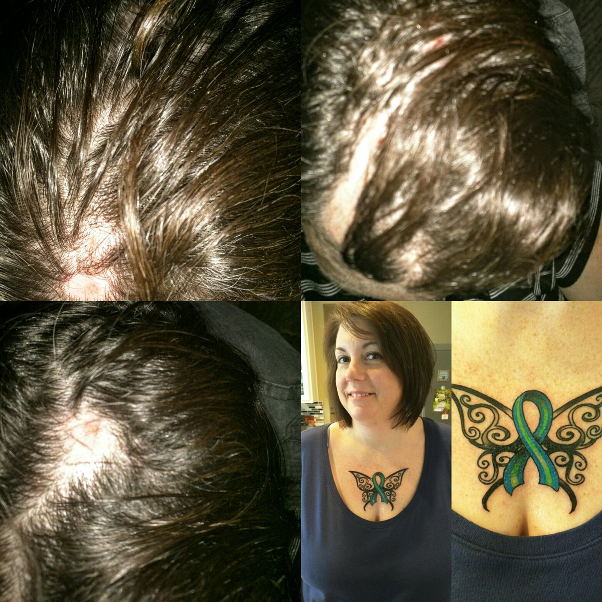CBish429's tweet photo. #Trichotillomania Here it is folks! #NotAshamed #Awareness https://t.co/1faBrzg3uw