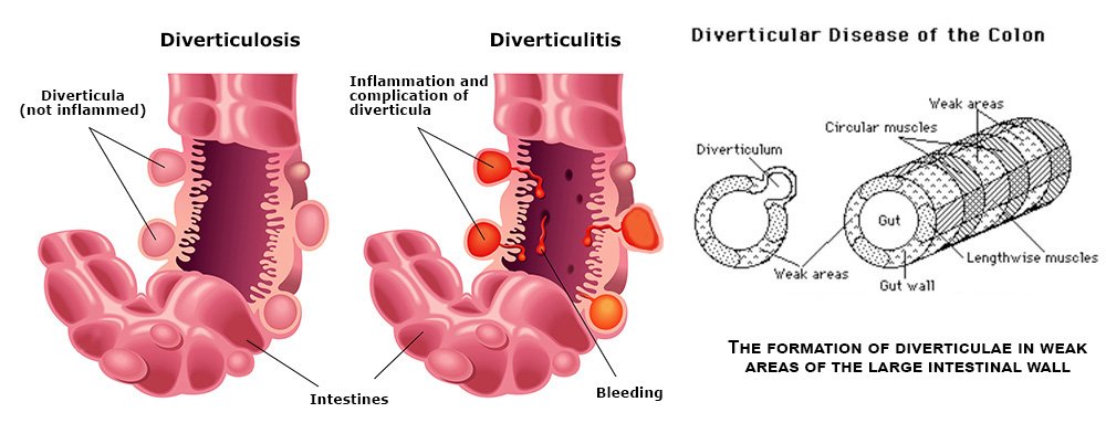 Diverticulitis y ansiedad