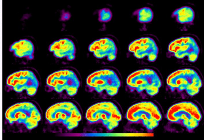 actualanalytics's tweet photo. New imaging technique in Alzheimer's disease opens up possibilities for new drug development https://t.co/homBRiq259 https://t.co/wWjAV0hxOL