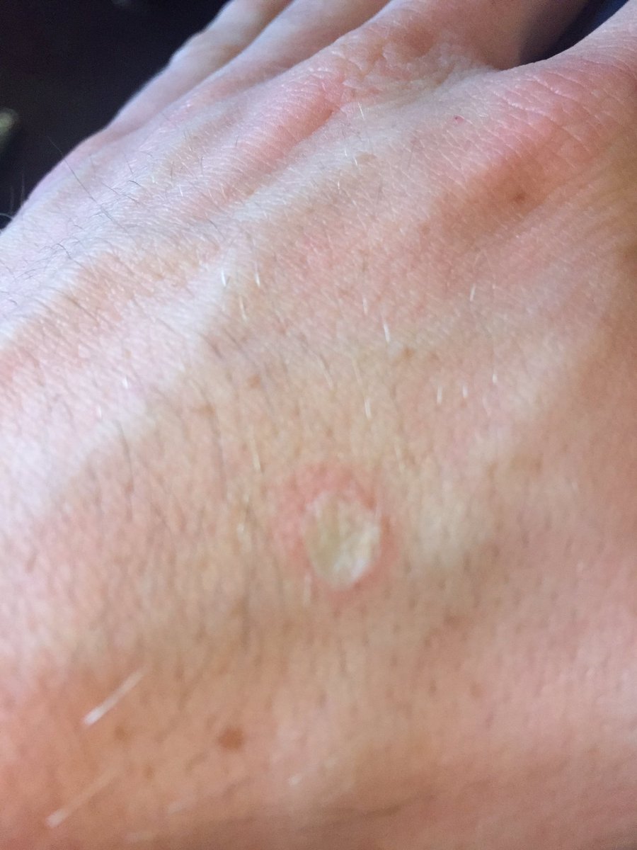 jkalgar's tweet photo. Don't talk shit to @PsychicBeginner #cigaretteburn #notkinky https://t.co/zGXAU9j63h