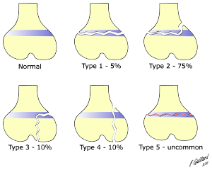 Fechter_b's tweet photo. Fractures that involves the epiphyseal plate or growth plate of a bone. Know your Salter-Harris fractures. #CincyAI https://t.co/PvhyNjmhN4