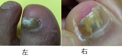 茶々は還暦エンジニア 爪水虫にマジ悩んでます 私の爪水虫と巻き爪とクリアネイルショットと重曹とクリップと T Co Qm6x14gdt0 T Co Pdeidn6bri Twitter