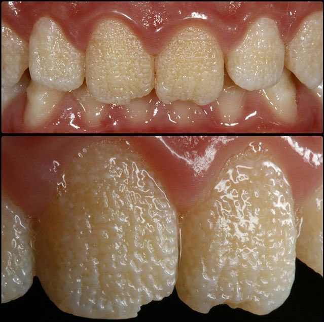 Amelogénesis imperfecta