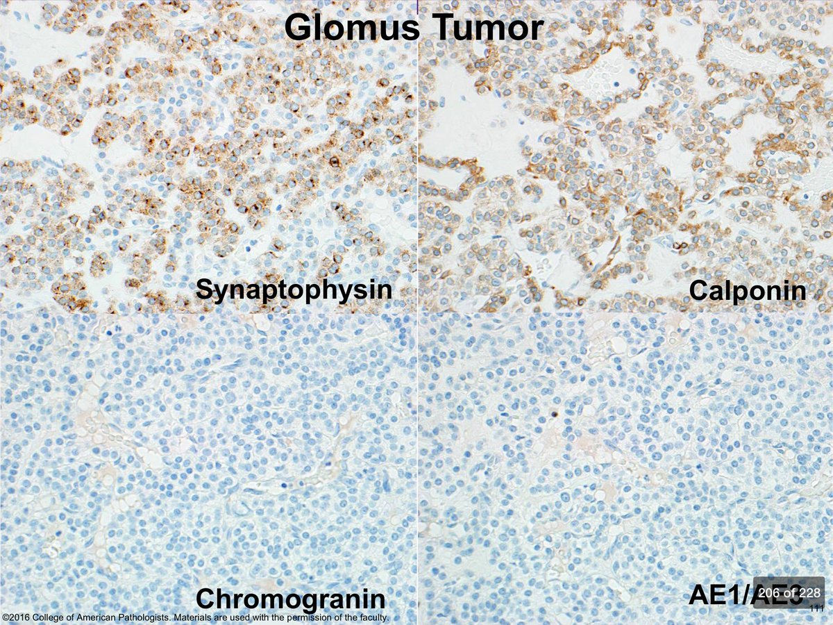 Glomus tumor of the stomach can mimic well-differentiated Neuroendocrine tumor. Immunostains can be helpful. #cap16