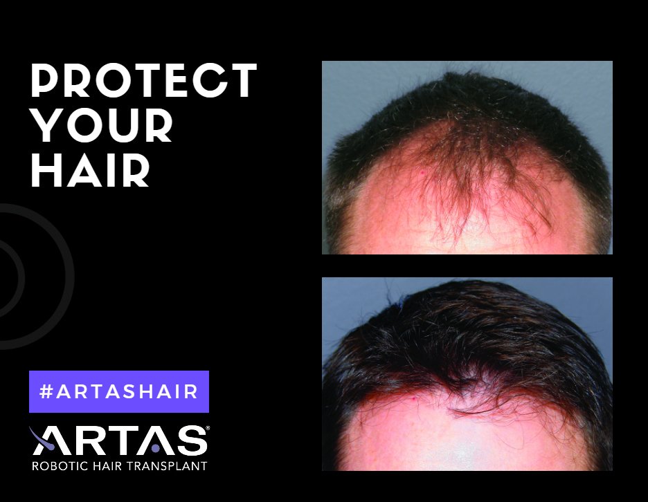 SalientMedical's tweet photo. The #ARTAS Robotic Procedure was designed with you, the patient, in mind! Find a physician near you - https://t.co/8I5lO8czjE #ARTAShair https://t.co/89lByb5kRi