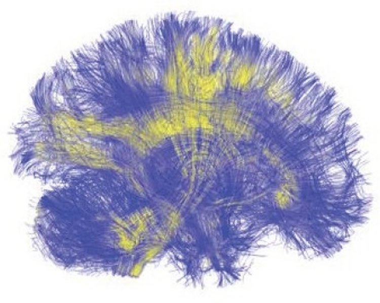 NeuroscienceNew's tweet photo. What Happens When the Brain is Artificially Stimulated https://t.co/Qp53mVuYT0 #neuroscience #science #TMS #psychology #whitematter https://t.co/iNiLUBZdnR