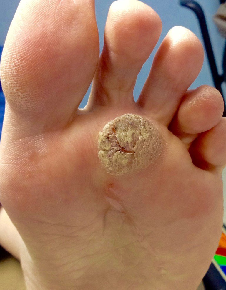 Dr Nick Campitelli On Twitter Dealing With Plantar Warts They Re Never Miss A Moment