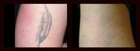 Laser Tattoo Removal tweet media