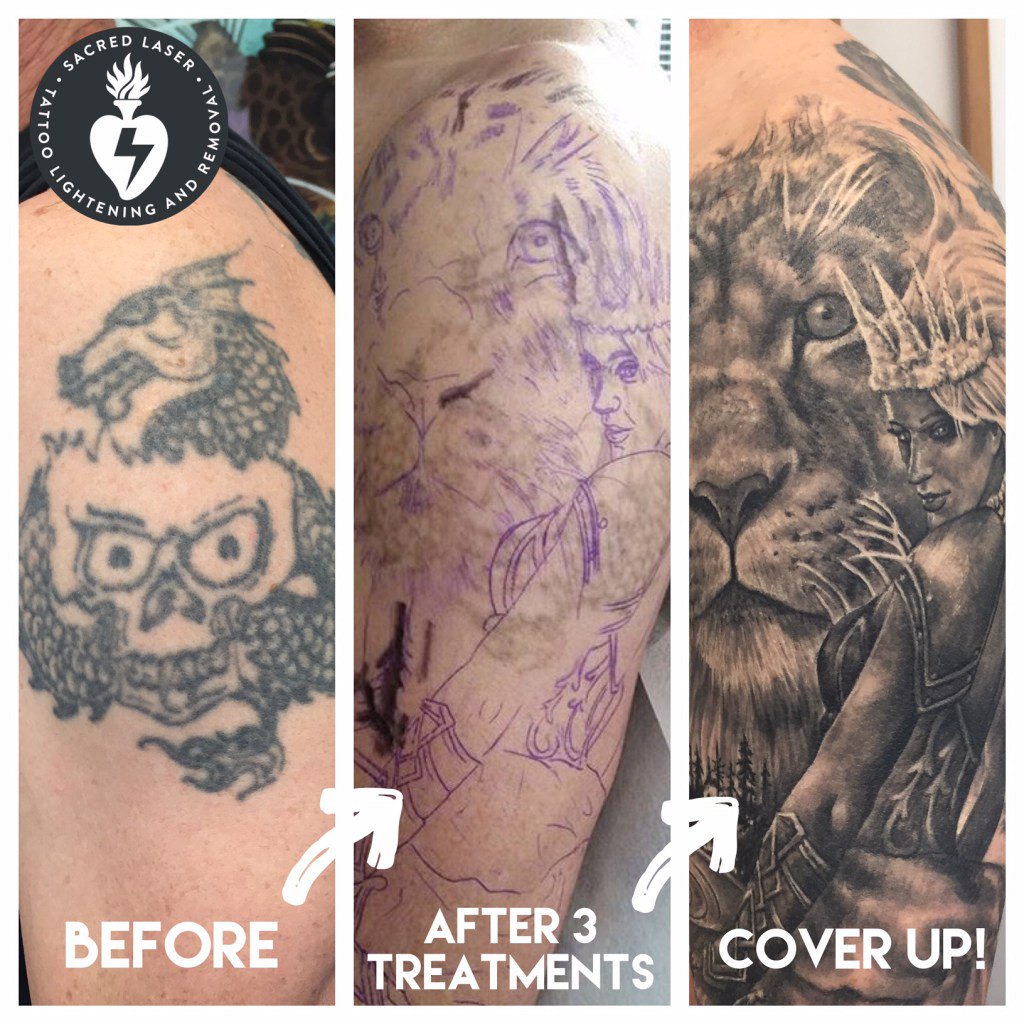 Laser Tattoo Removal Everything You Need to Know SD Botox #32 Laser Tattoo Removal Everything You Need to Know SD Botox