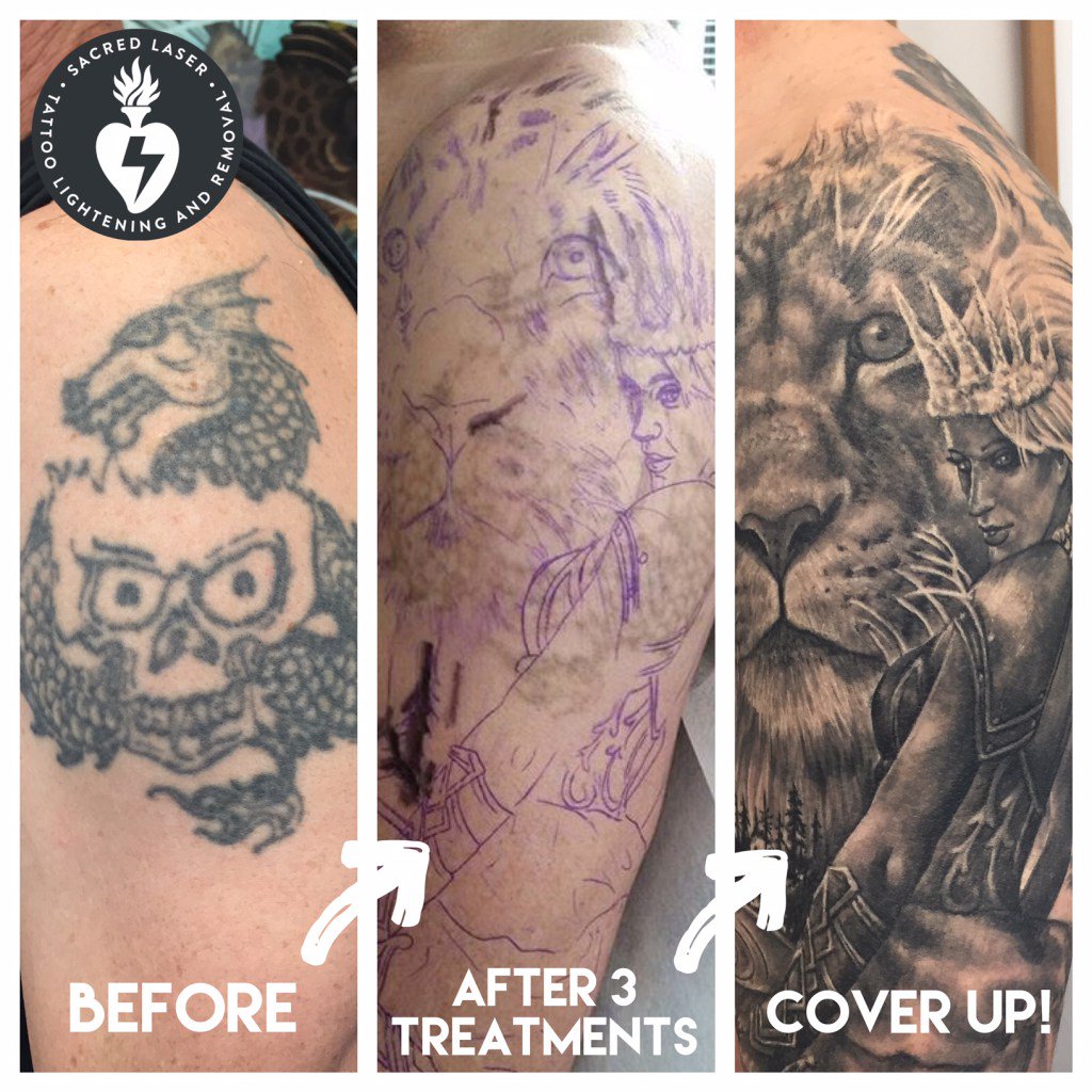 Laser Tattoo Removal  Enlighten Latest and Most Effective  TechnologyFastest ResultsHartford CT