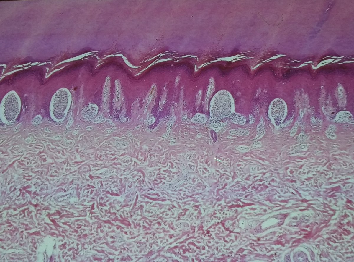 edusqo's tweet photo. Calonje E at #ESPIAPCologne2016. Melanocytic Tumours: Acral Naevi. #DermPath #insitupathologists https://t.co/s6MZEUZ686