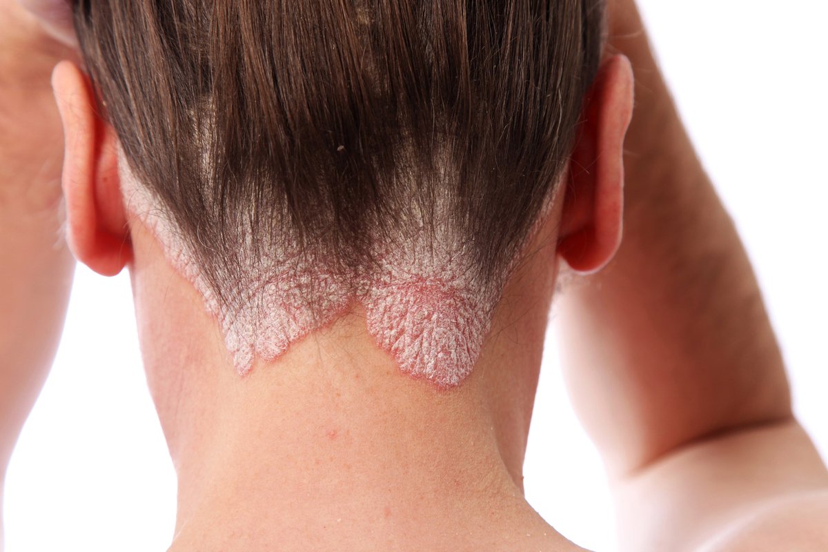 NIH_NIAMS's tweet photo. #PsADAY16 Some people w/ #psoriasis develop pain, stiffness & joint damage of #psoriatic arthritis. For more info: https://t.co/9xHFrUlNnS. https://t.co/XujrXlRQqq