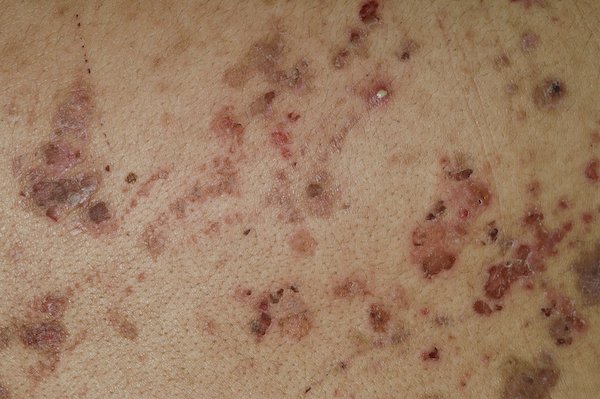 medicusmeo's tweet photo. #Pénfigo; no es una enfermedad contagiosa y su causa exacta se desconoce https://t.co/KvIpJTy41T https://t.co/ekraaSevIN