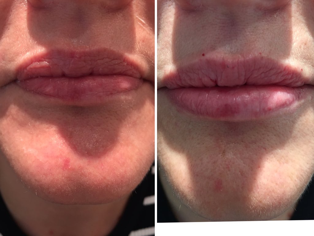 riveraesthetics's tweet photo. Correction of lower lip asymmetry #proportion #beauty @PerfecthaUK @SilhouetteSoft #naturallip @SaveFaceUK https://t.co/JTbOA2NQz2