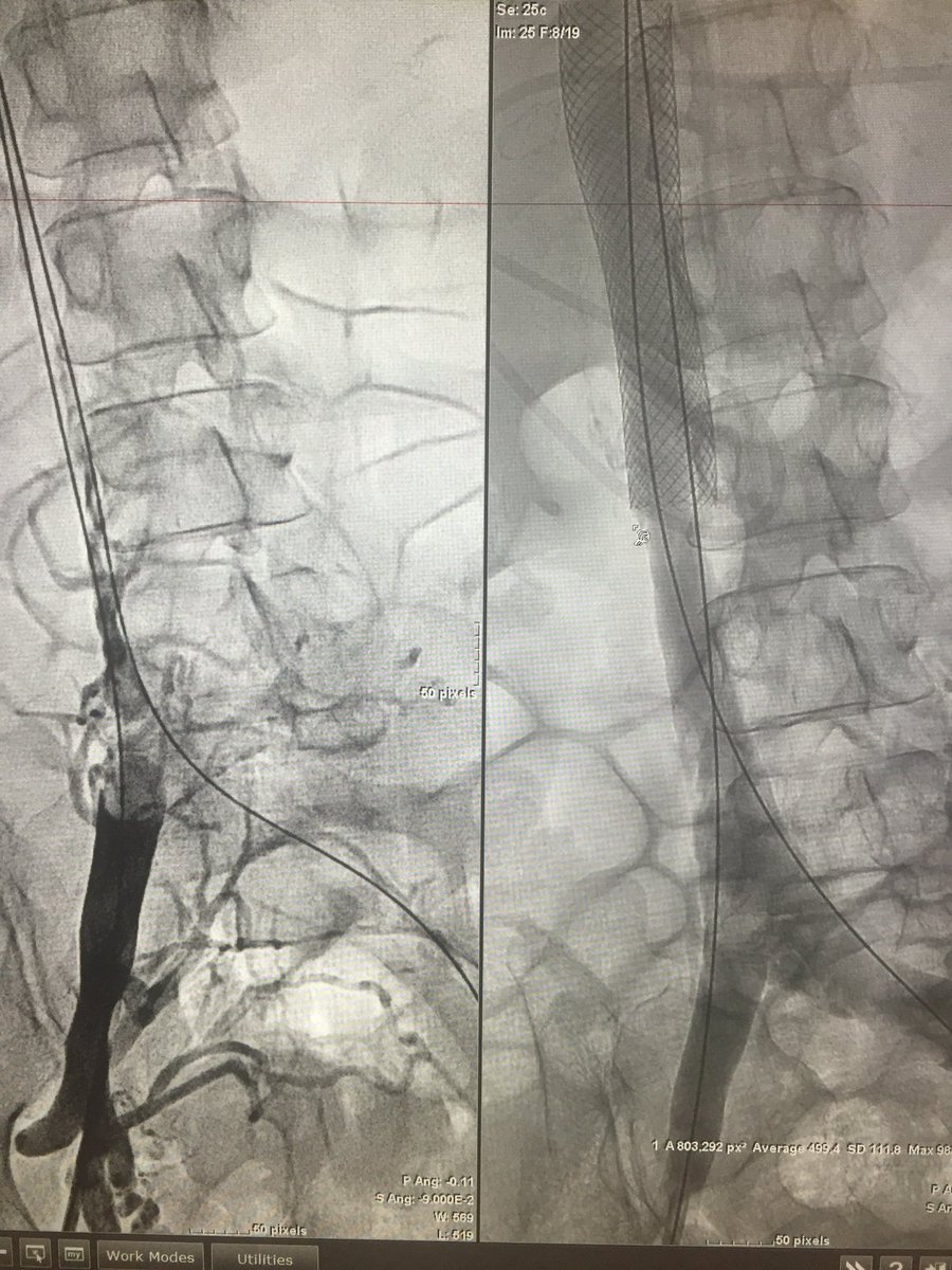 #DVT.  IVC thrombosis. Single Session Endovascular Tx. #zelante <a href="/MountSinaiIR/">Mount Sinai IR</a> <a href="/bsc_pi/">Jeff Mirviss</a> <a href="/EVToday/">Endovascular Today</a>
