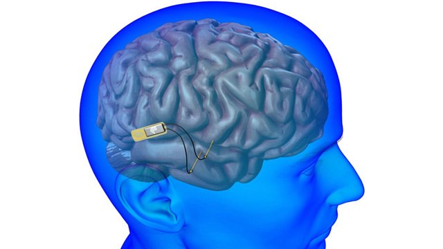 El concepto de Brainjacking comienza a tomar presencia. Con un implante en el cerebro, ¿podrán llegar a hackearlo? goo.gl/buHm8y