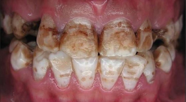 Fluorosis dental