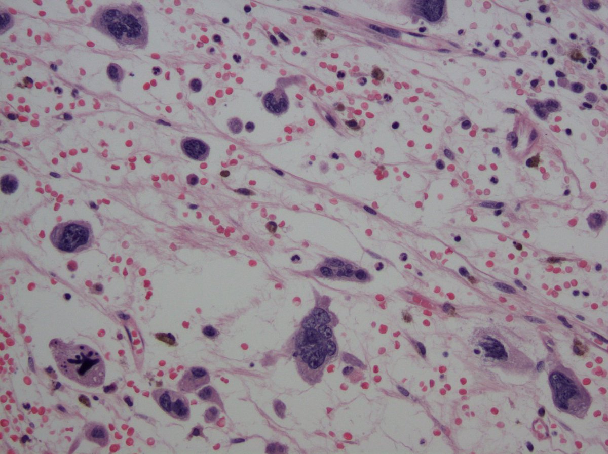 UAMS Hemepath tweet media