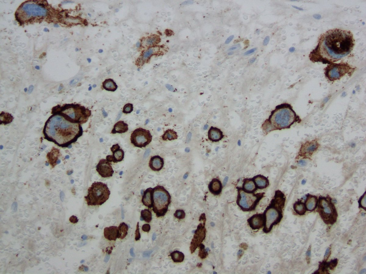 UAMS Hemepath tweet media