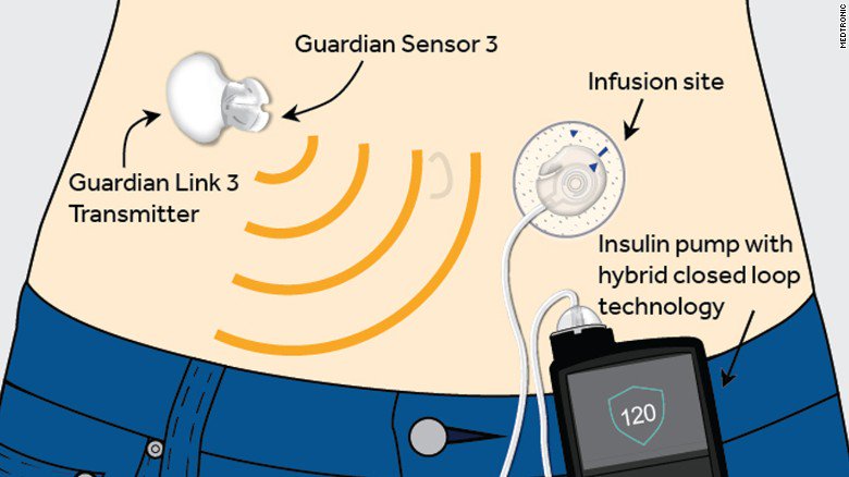 CNN's tweet photo. "Artificial pancreas" designed to monitor and treat type 1 diabetes wins FDA approval https://t.co/uMYtYjfHUa https://t.co/uJaBJ1wsUV