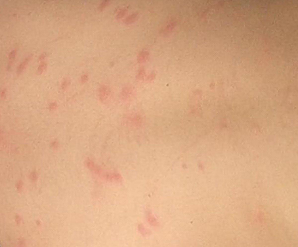 A Mysterious Rash Is Spreading Among Children And Staff At An