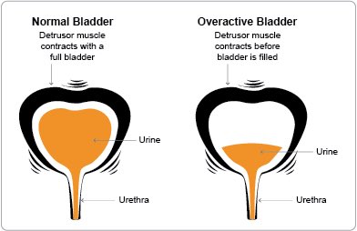Treat #OveractiveBladderSyndrome with pelvic-muscle strengthening,
behavioral therapies, medications, neuromodulation, or surgery #healthtip