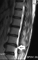 PTRClinic1's tweet image. #Spinaldisc pathology can cause leg and/or #backpain -if you&apos;re suffering call us for a consultation 0207 935 4750