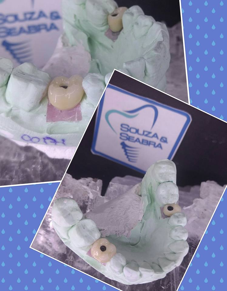 souzaeseabra's tweet photo. Coroas Metalo-Ceramicas...
#souzaeseabra #laboratoriodeprotese #protesedentária #prótese #protesedental #ceramista #dentaldesign #protetico https://t.co/OoQNm5TeX2