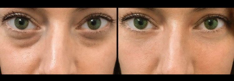 ShethDerm's tweet image. Say #byebyeundereye with tear trough fillers! Book your appointment at Sheth Dermatology! 708-323-3376