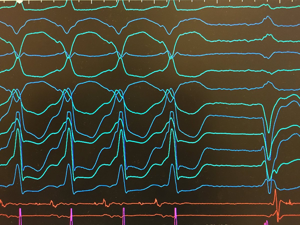 DrRoderickTung's tweet image. Beauty of #vtach ablation. Low amplitude bystander component in front of critical presystolic site, split late potential during sinus.