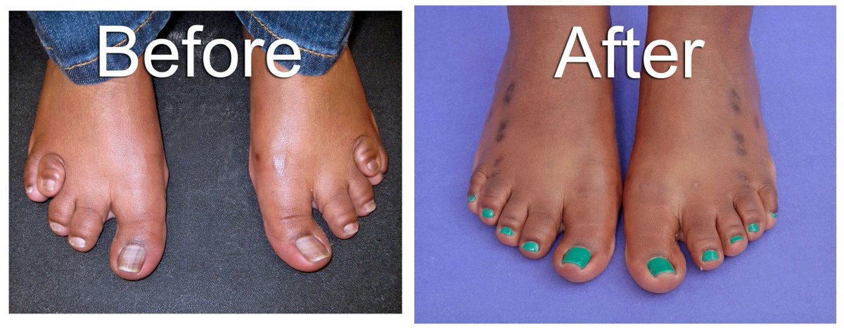 Paley Orthopedic Spine Institute On Twitter Dr Lamm Treats Brachymetatarsia With A Toe Lengthening Check Out These Amazing Before And Afters