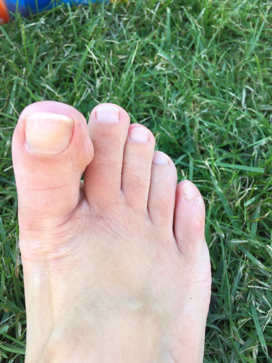 janeatherton71's tweet photo. Blistered but happy @chestermarathon #subthree https://t.co/PQqpklVixL