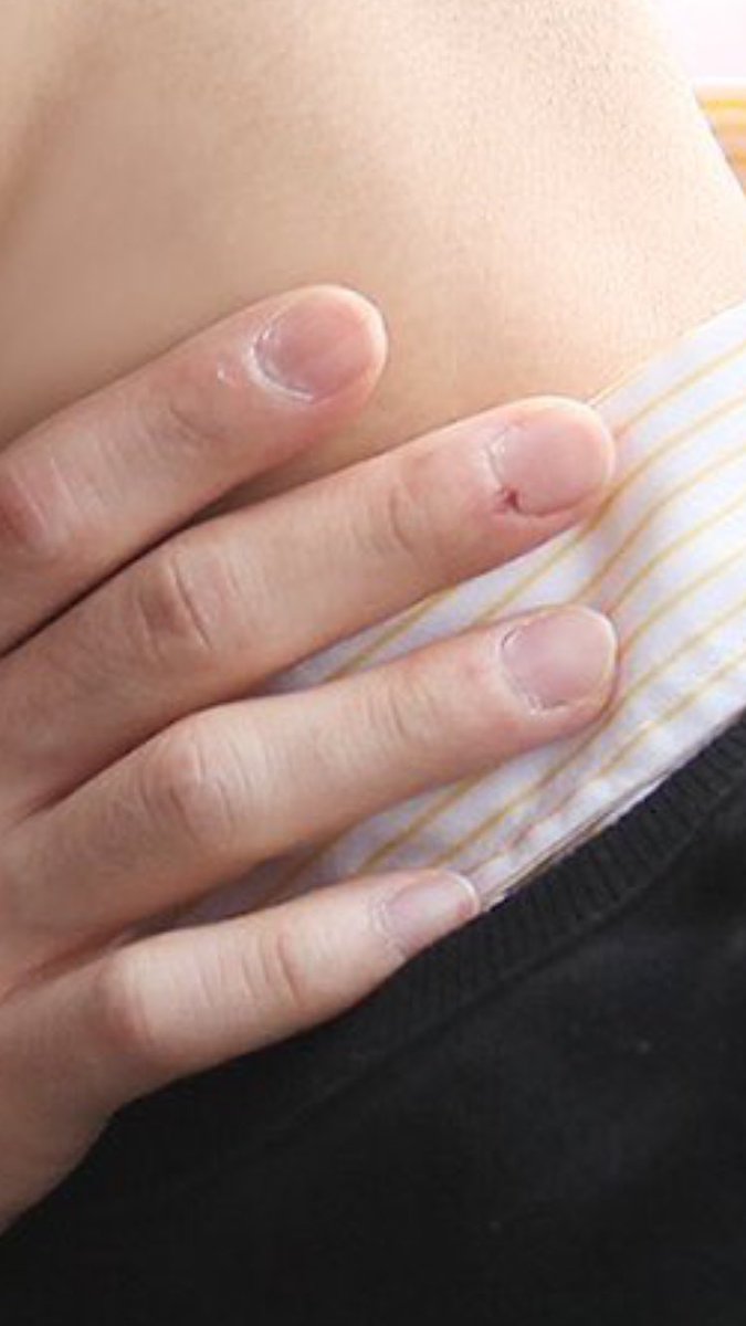 ncttennn's tweet photo. poor baby with damaged cuticles https://t.co/VueTKuMjsw
