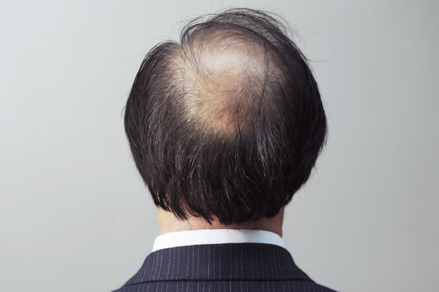 薄毛の人が避けるべきヘアスタイル４つのngパターン