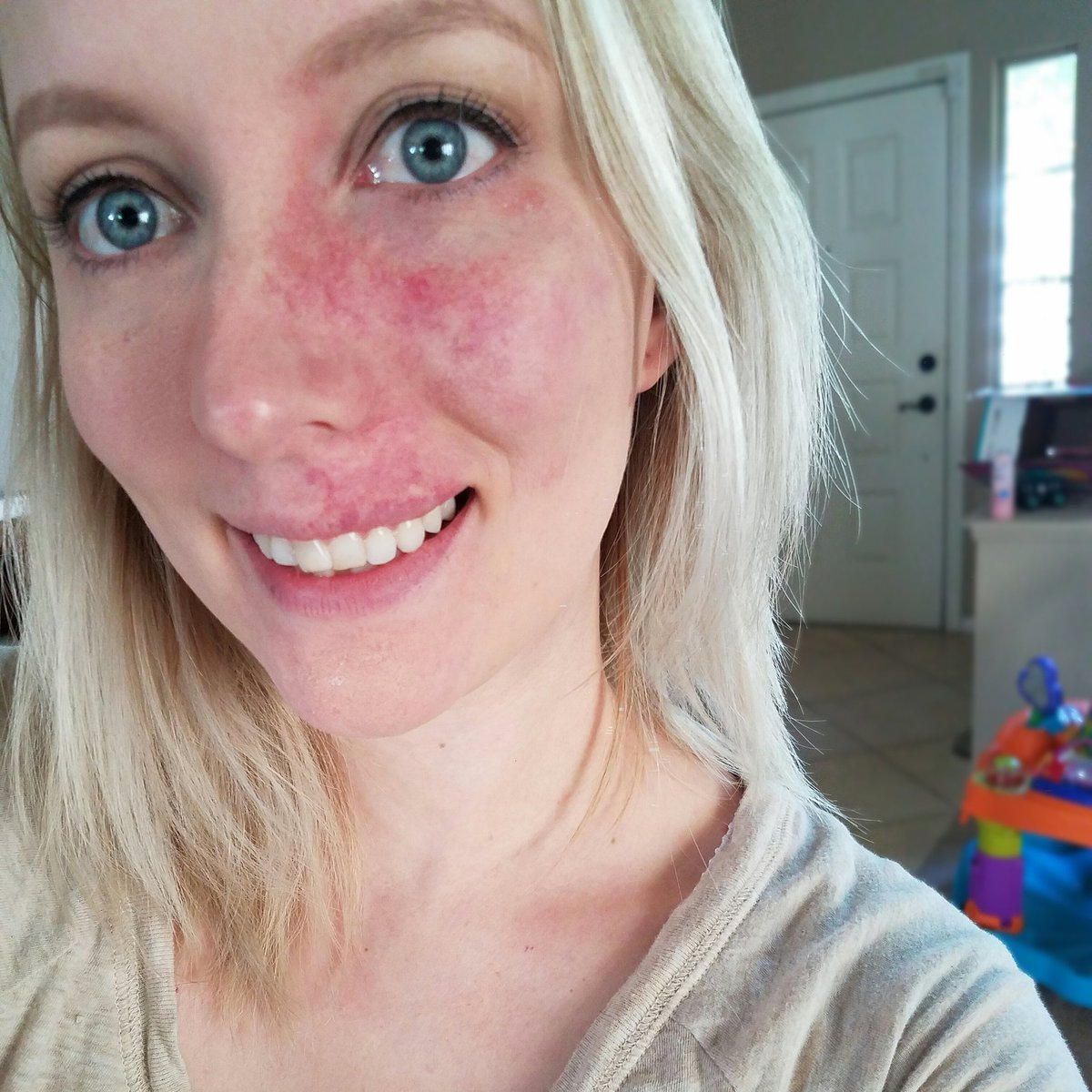 Beautymarked22's tweet photo. Positive point on having a large birthmark on my face... I get to weed out insensitive people who only care about looks 😄 ha! https://t.co/pwR5rp74Nb