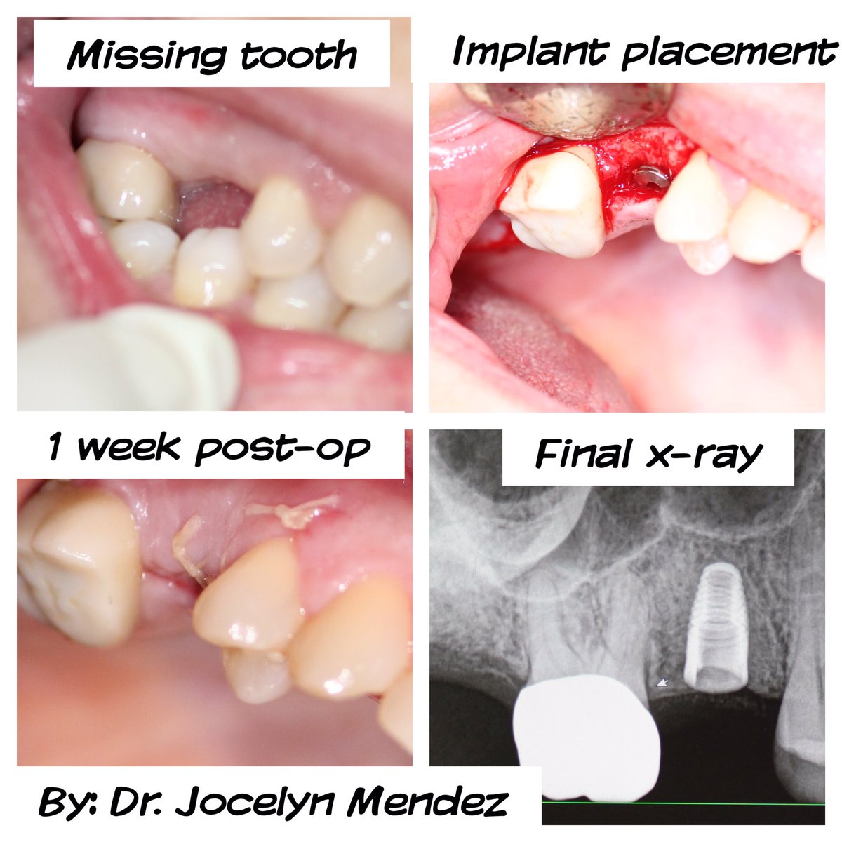 GroveDentist's tweet photo. Are you missing a tooth? #implants #Miami #MiamiDentist #SmileMakeover https://t.co/DP0IJZiFdj
