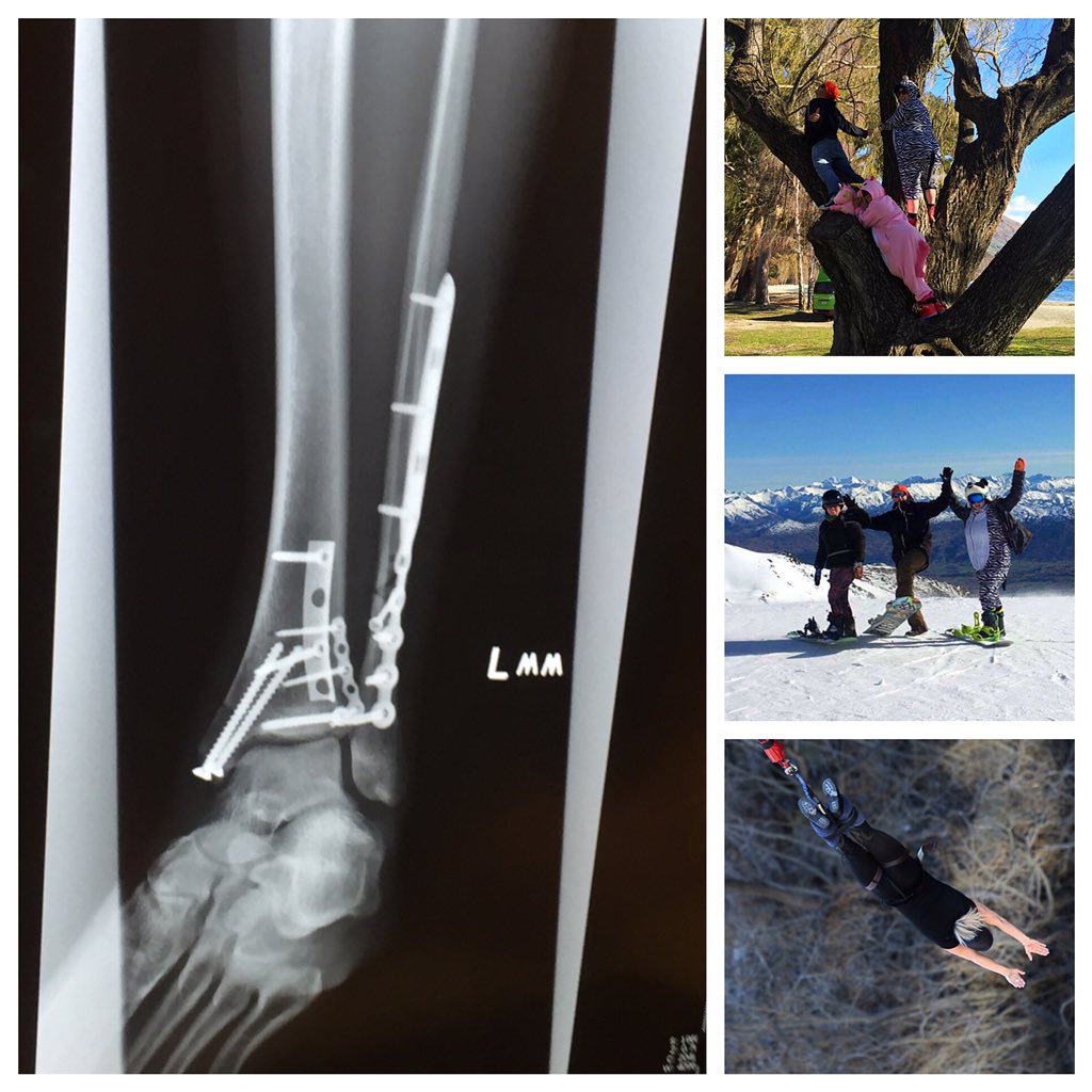tcodid's tweet photo. Shattered my ankle skydiving in February. Hurts like hell but won't stop me #rideordie #shredlife #rebuildpower https://t.co/TtRFjyHhXg